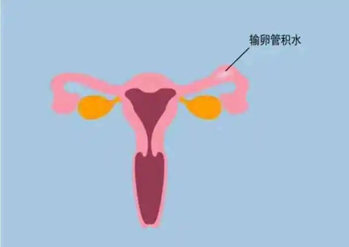 这些输卵管积水的征兆你有吗?