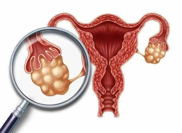 子宫囊肿让人不省心