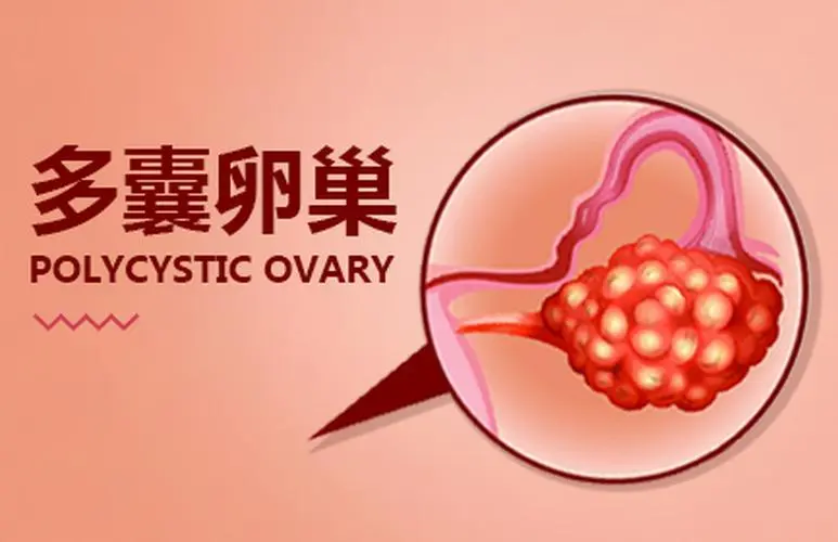 得了多囊卵巢综合征还能生育吗?