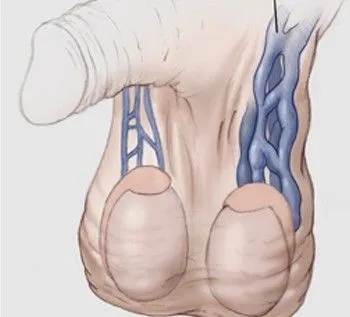 造成精索静脉曲张的原因有哪些?